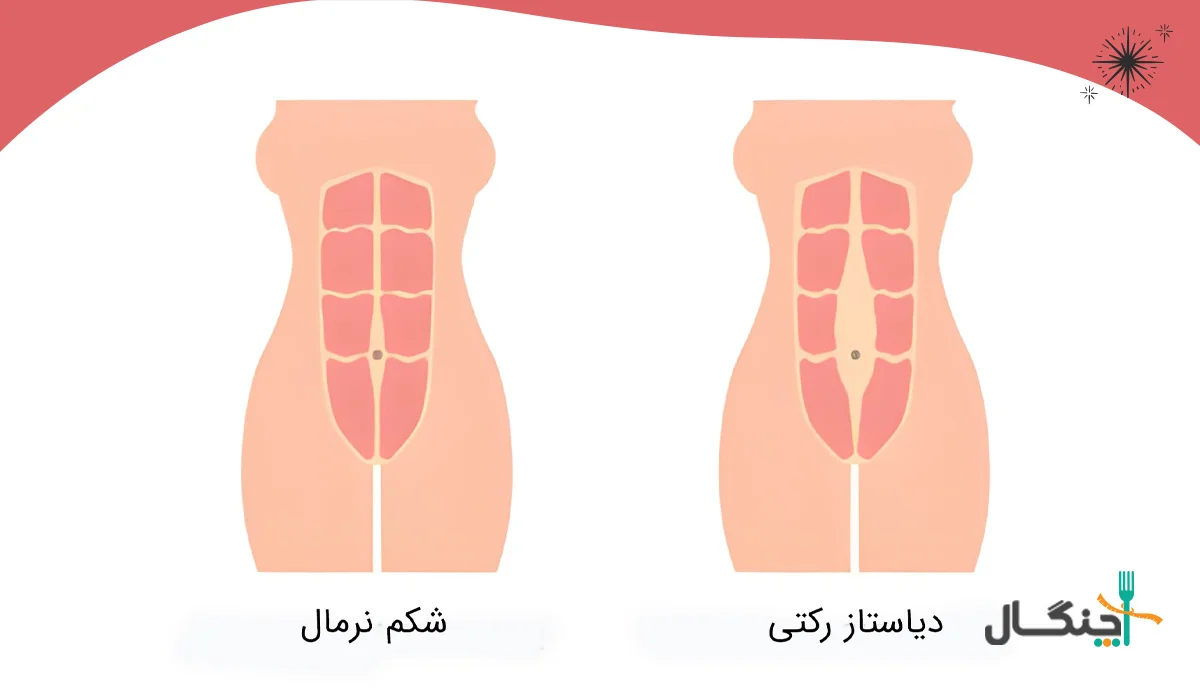دیاستاز رکتی و چاقی شکمی بعد از زایمان